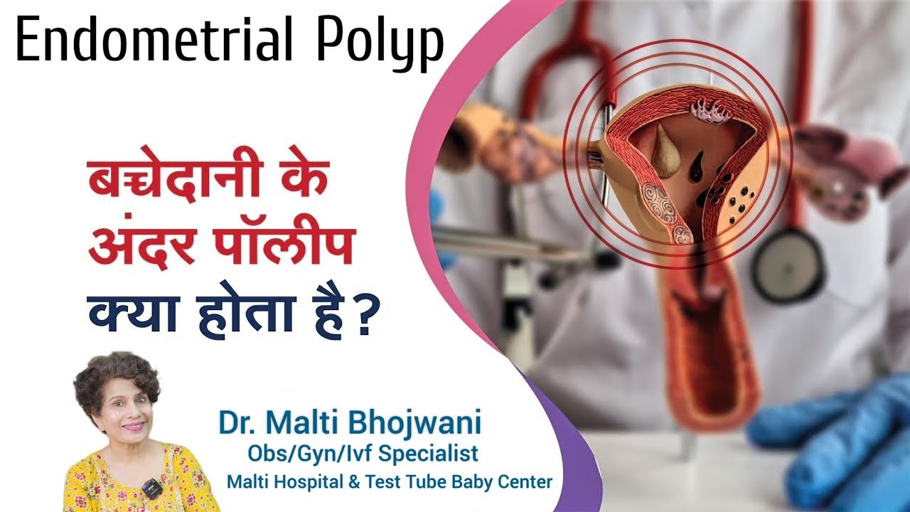 What is an Endometrial Polyp ? | बच्चेदानी के अंदर पॉलीप - क्या होता है ?