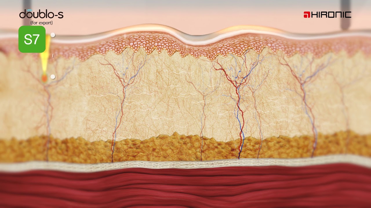 HIFU in Singapore: Doublo Non-Invasive Skin Lifting Treatment