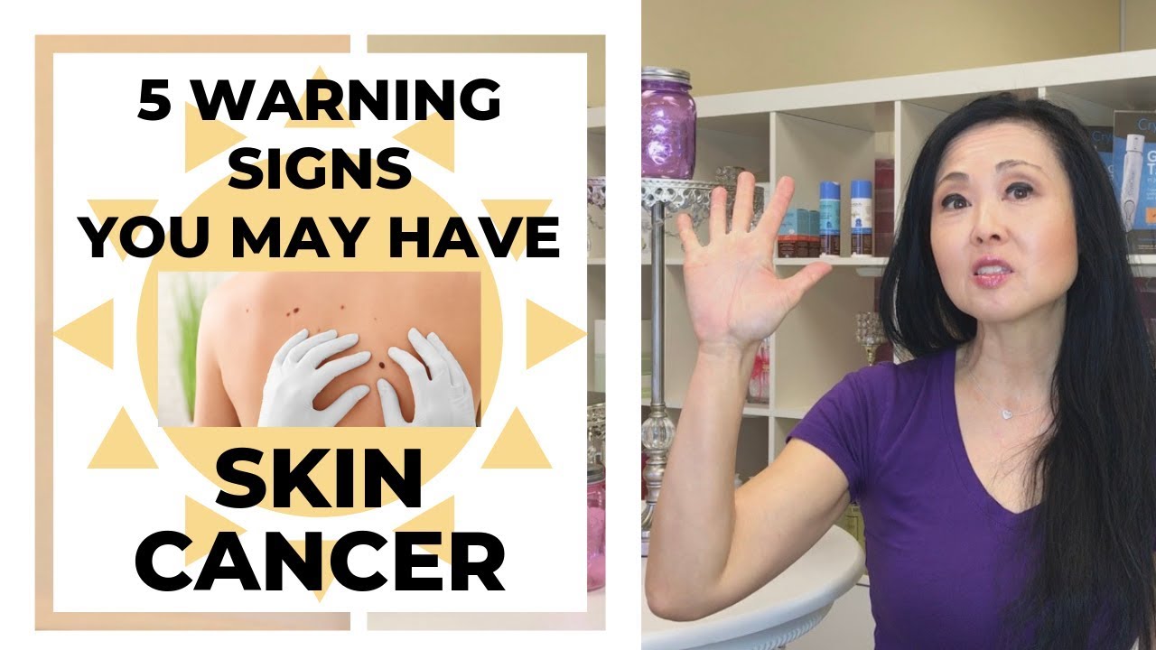 5 Warning Signs You May Have Skin Cancer
