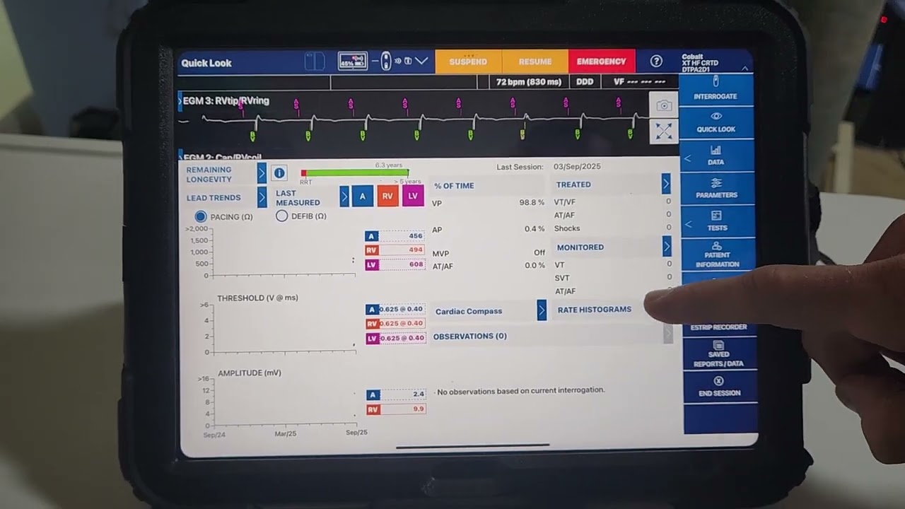 Программирование Medtronic Cobalt CRT-D после имплантации (практически завершено)