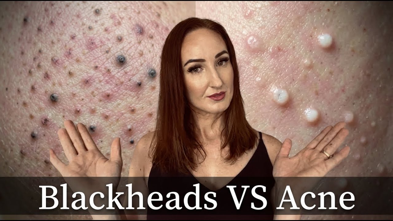 Your Treating the Wrong Thing: Acne vs Blackheads Explained