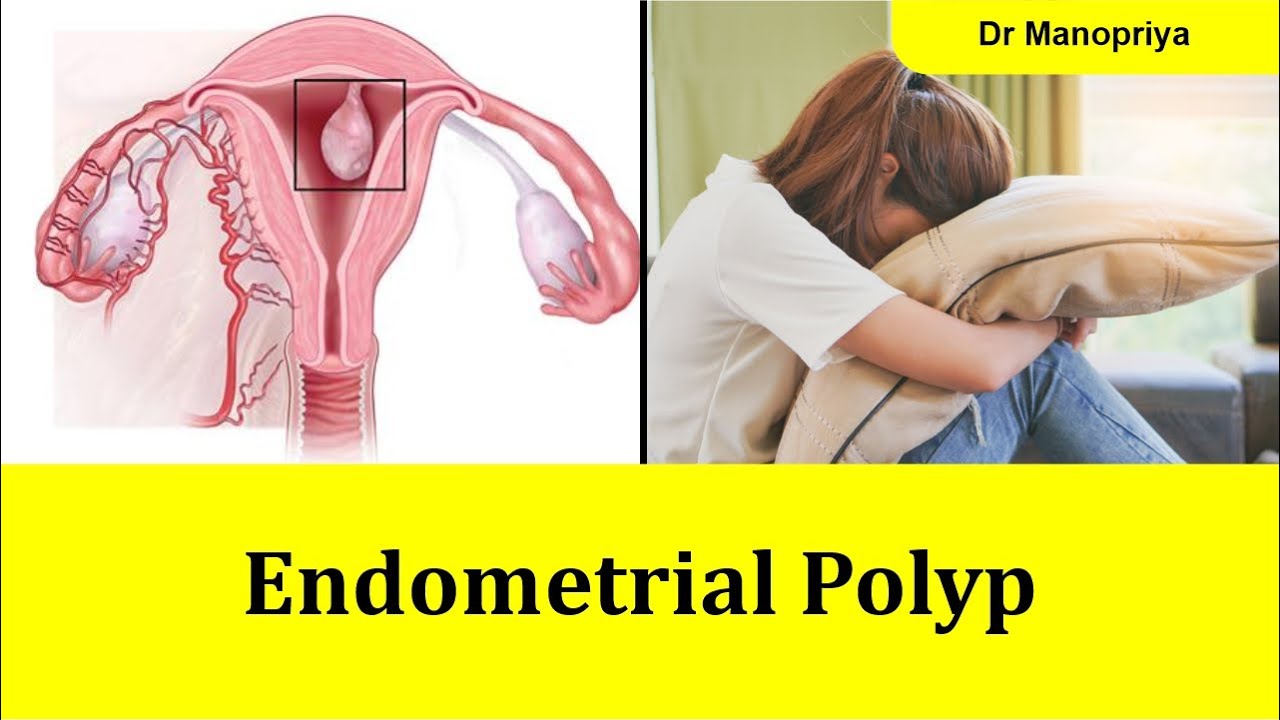 Endometrial polyp can I get pregnant in Tamil