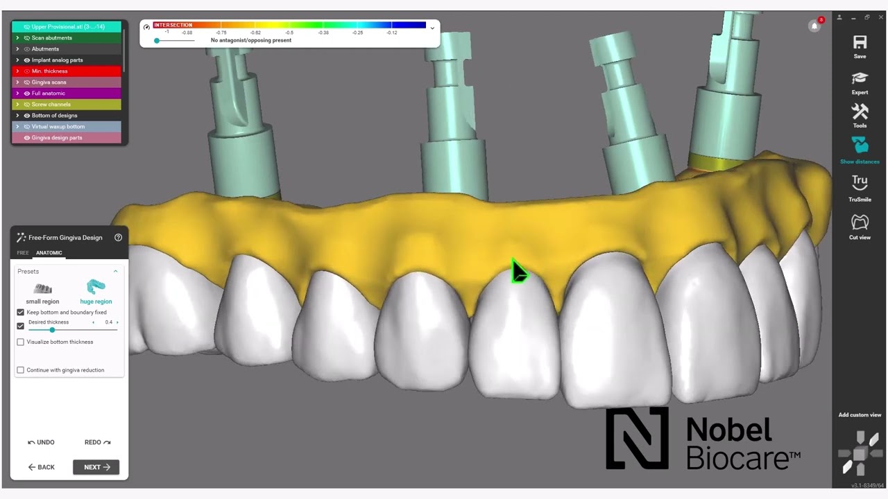 How to design your NobelProcera® Full-contour Zirconia Implant Bridge using exocad™