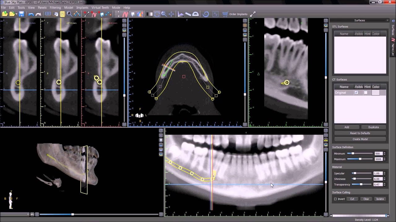 Automatic Nerve Detection. Blue Sky Plan Training Tutorial