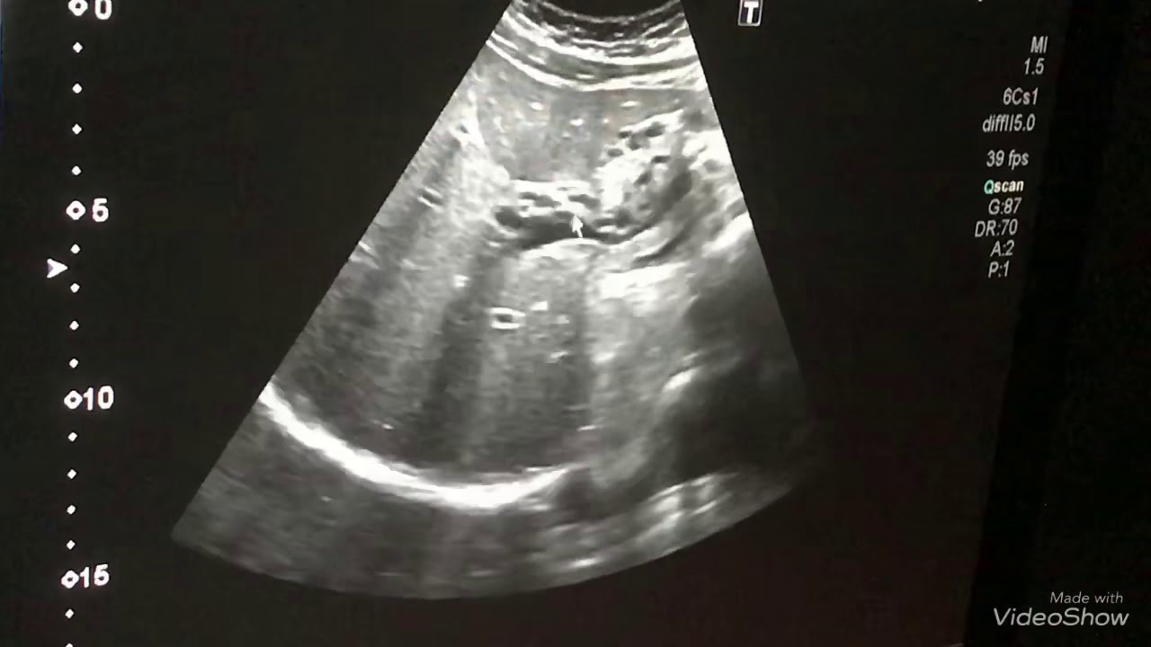 Abdomen Ultrasonu, Ultrason kursu. Bauchultraschall, Ultraschallkurs.
