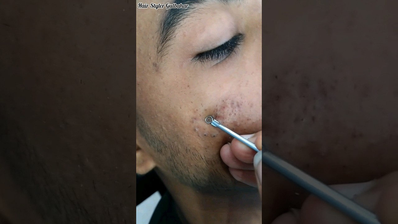 How to remove face blackheads #shorts #hairstylergulbahar