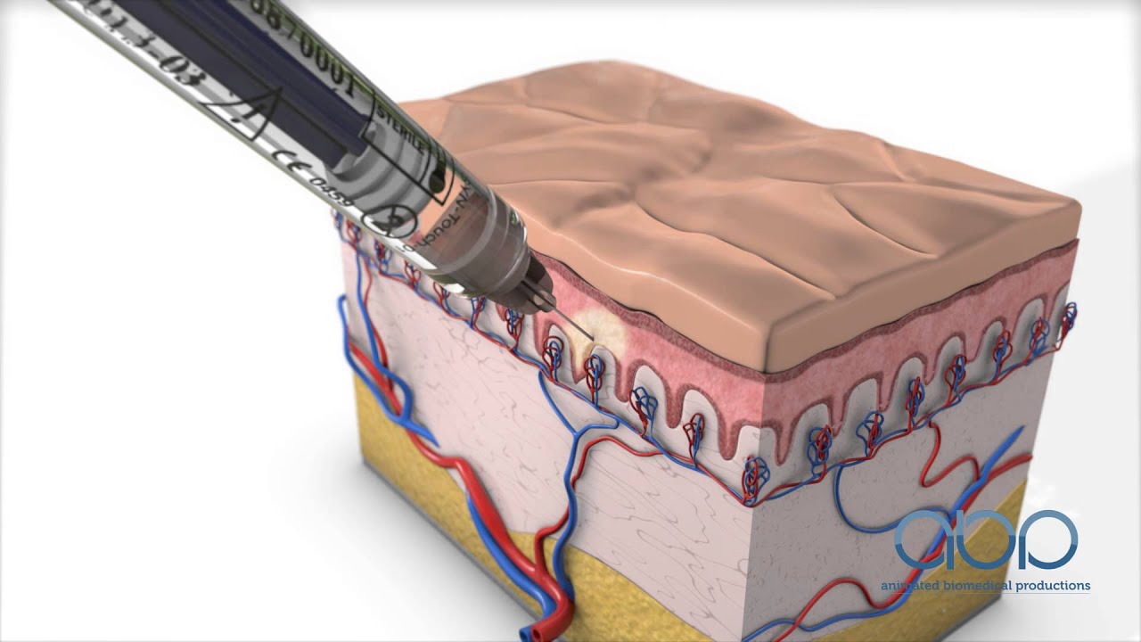 Collagen Injection