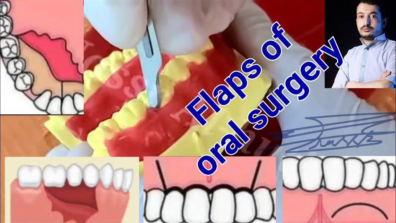 Basic principles of flap ( envelope, trapezoid, triangular and semilunar ) #dentalstudent #dentistry