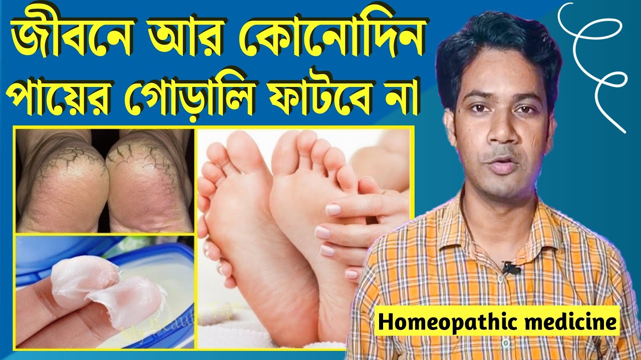 জীবনে আর কোনদিন পায়ের গোড়ালি ফাটবে না | পা ফাটা দূর করার উপায় | পা ফাটার হোমিও চিকিৎসা |Crackheel