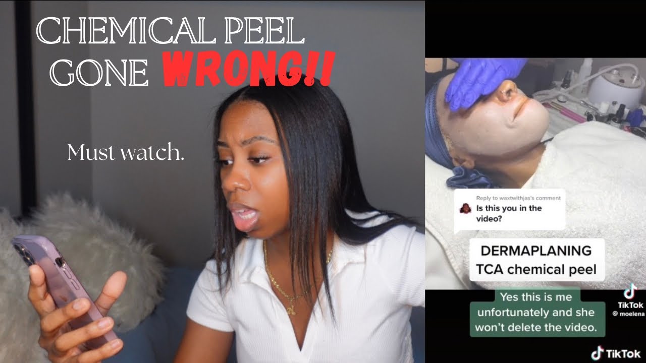 Esthetician Reacts to HORRIBLE CHEMICAL PEEL| Chemical Peel Breakdown