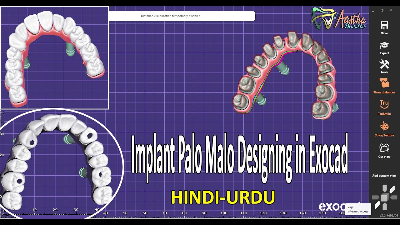 full mouth dental implants - all on 4 design technique in exocad