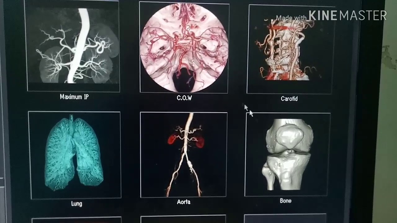 كيفية عمل فحص اشعة مقطعي علي مفصل الركبة ؟؟؟؟