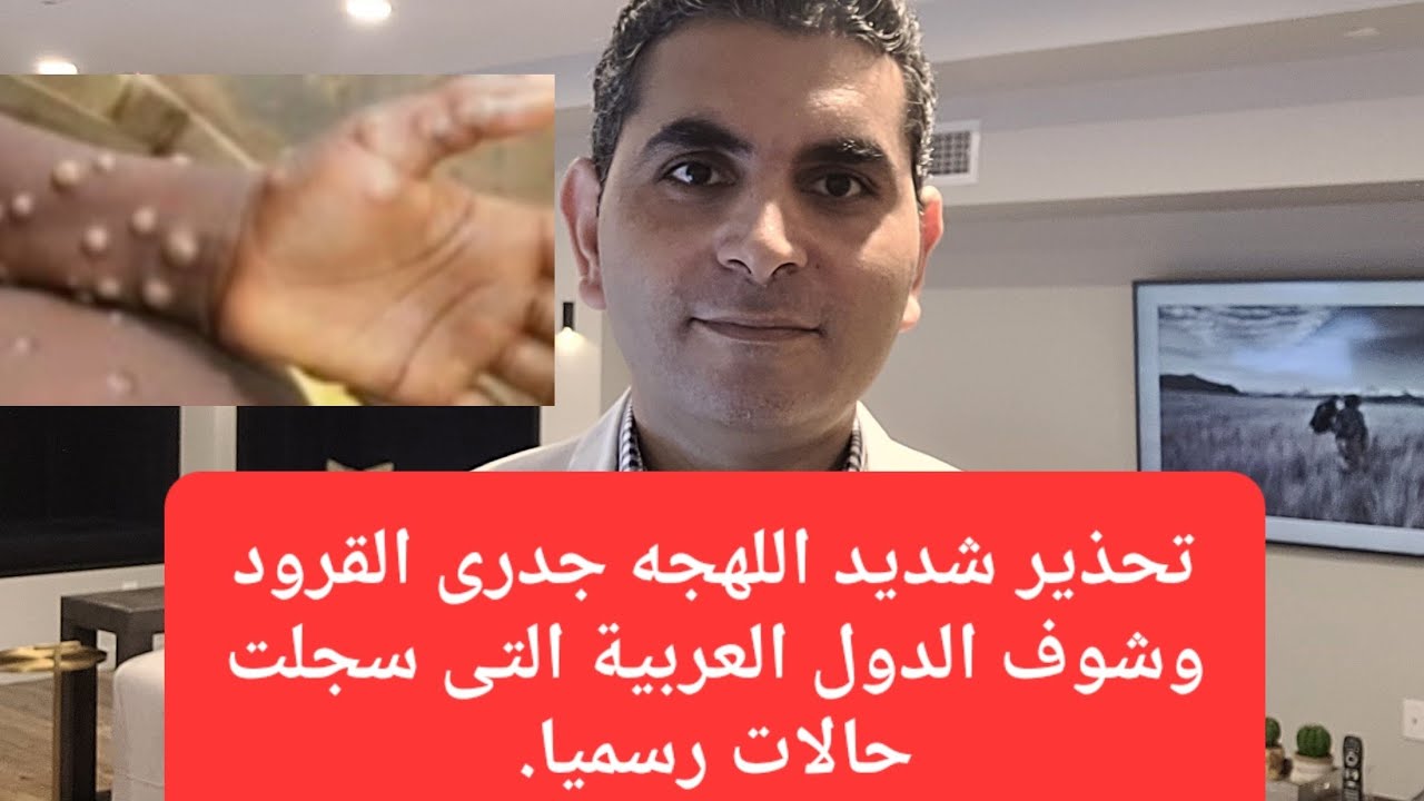 تحذير شديد اللهجه جدرى القرود وشوف الدول العربية التى سجلت حالات رسميا.