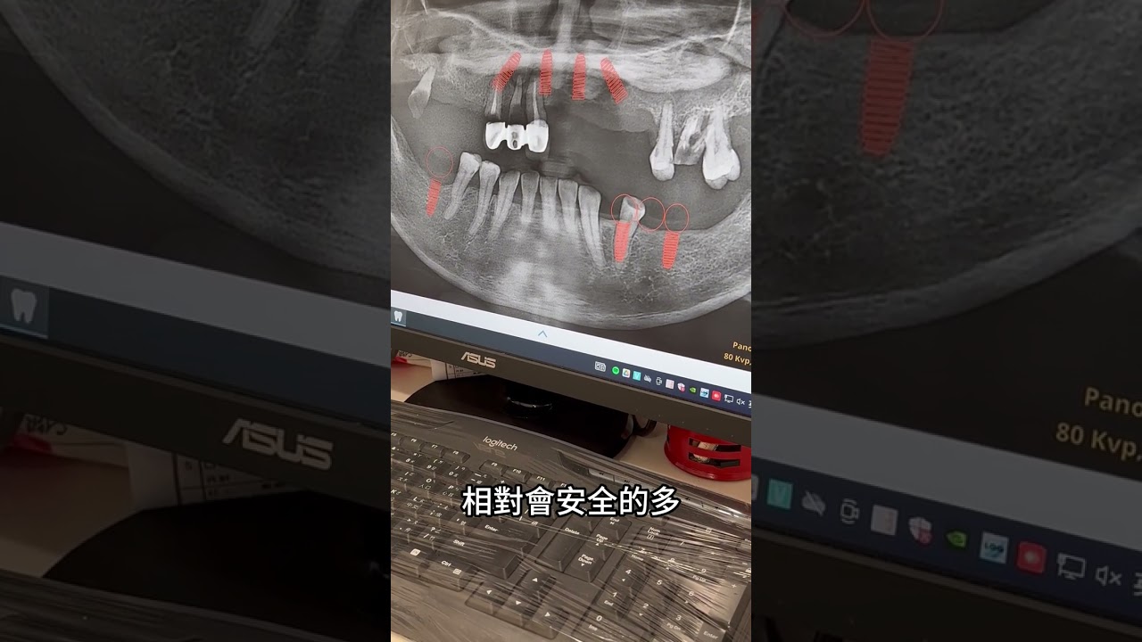 all on 4用顴骨植牙好嗎