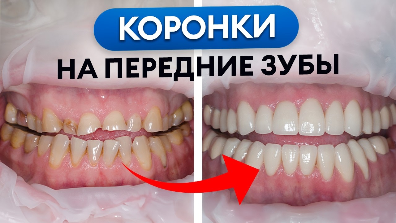 Зубные КОРОНКИ на ПЕРЕДНИЕ ЗУБЫ! / Все о ПРОТЕЗИРОВАНИИ передних зубов