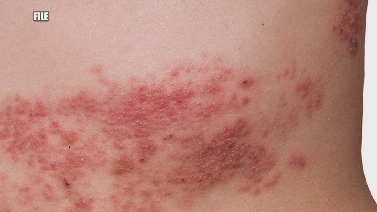 When shingles strikes: painful rash affects 1 in 3 adults