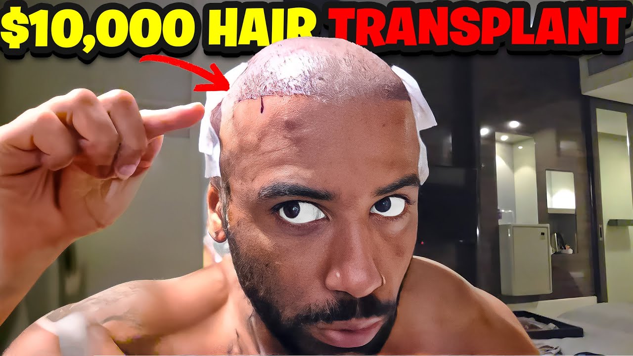 I WENT TO TURKEY AND GOT A $10,000 HAIR TRANSPLANT!
