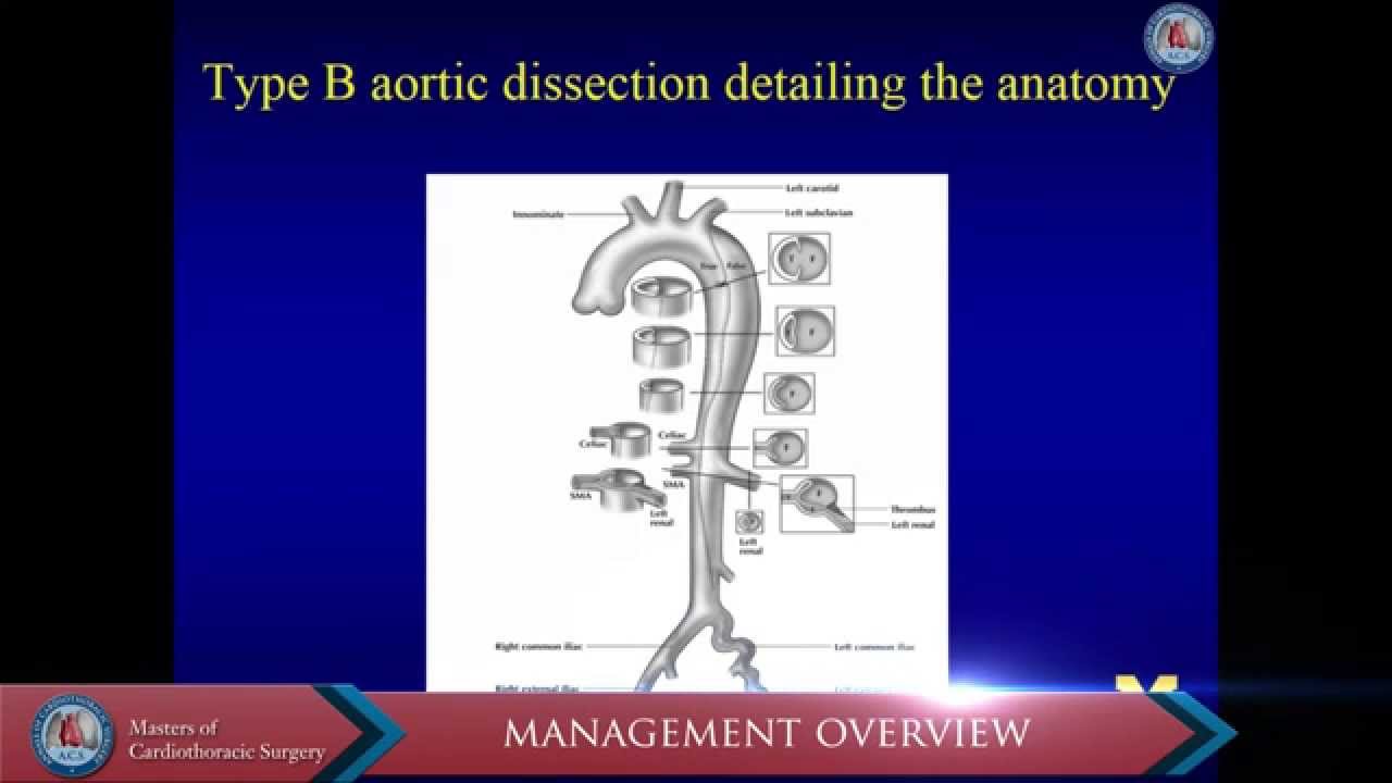 TEVAR for complicated acute type B dissection with malperfusion