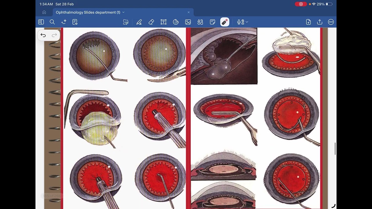Slides for undergraduates (ophthalmology) part 2