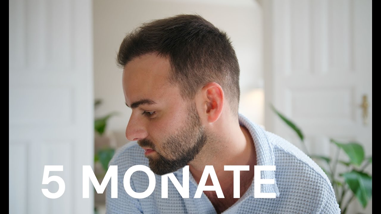 5 Monate nach meiner Haartransplantation bei Elithair | Fortschritt, Wachstum & ehrliches Fazit