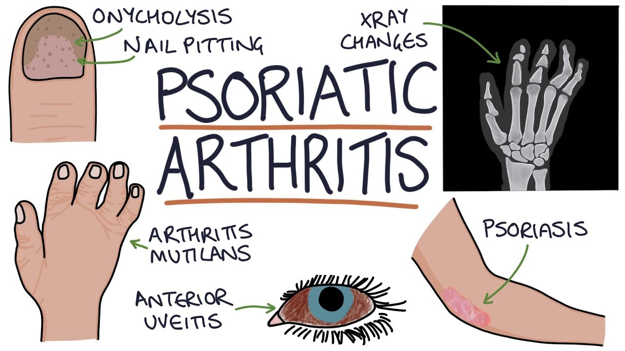 Psoriatic Arthritis