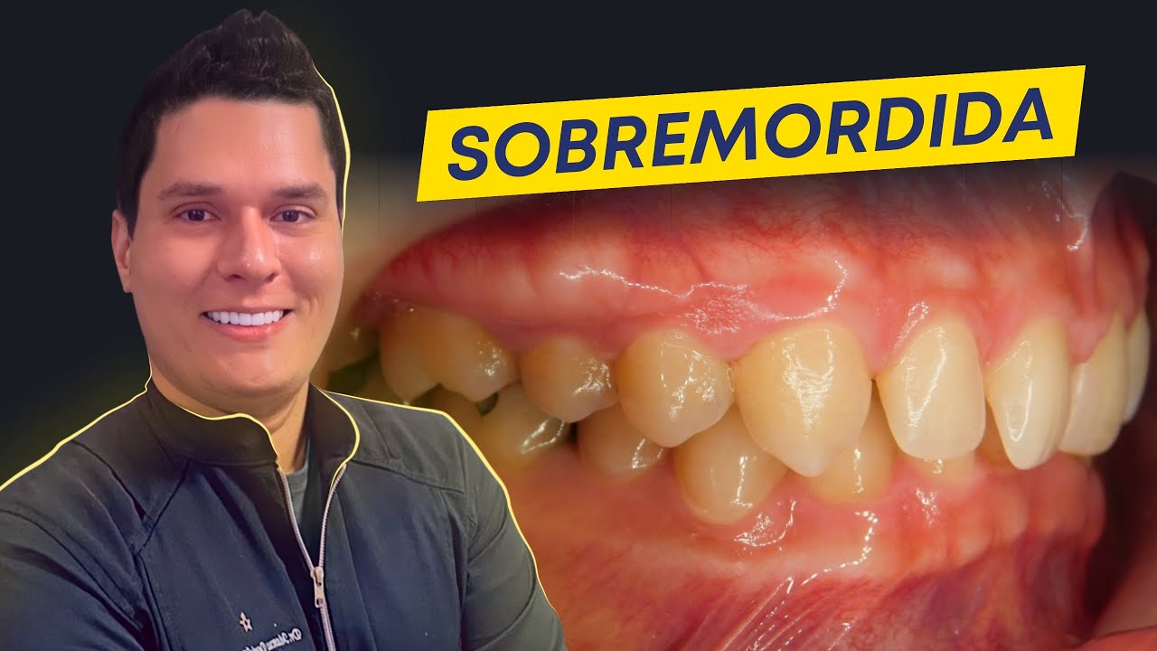 SOBREMORDIDA: COMO CORRIGIR? (GUIA COMPLETO).