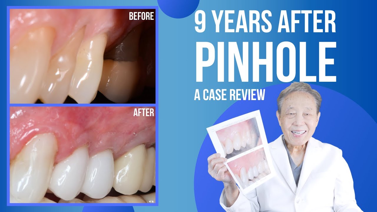 9-Year Follow-Up Case Review: The Pinhole&reg; Surgical Technique in Action