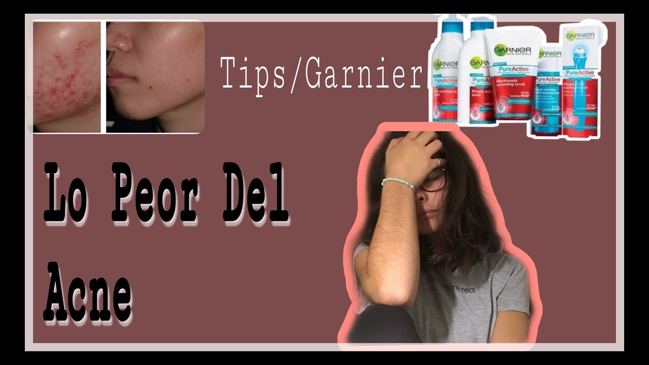 COMO ME QUITE EL ACNÉ ? Tips/productos garnier / EvDayann•
