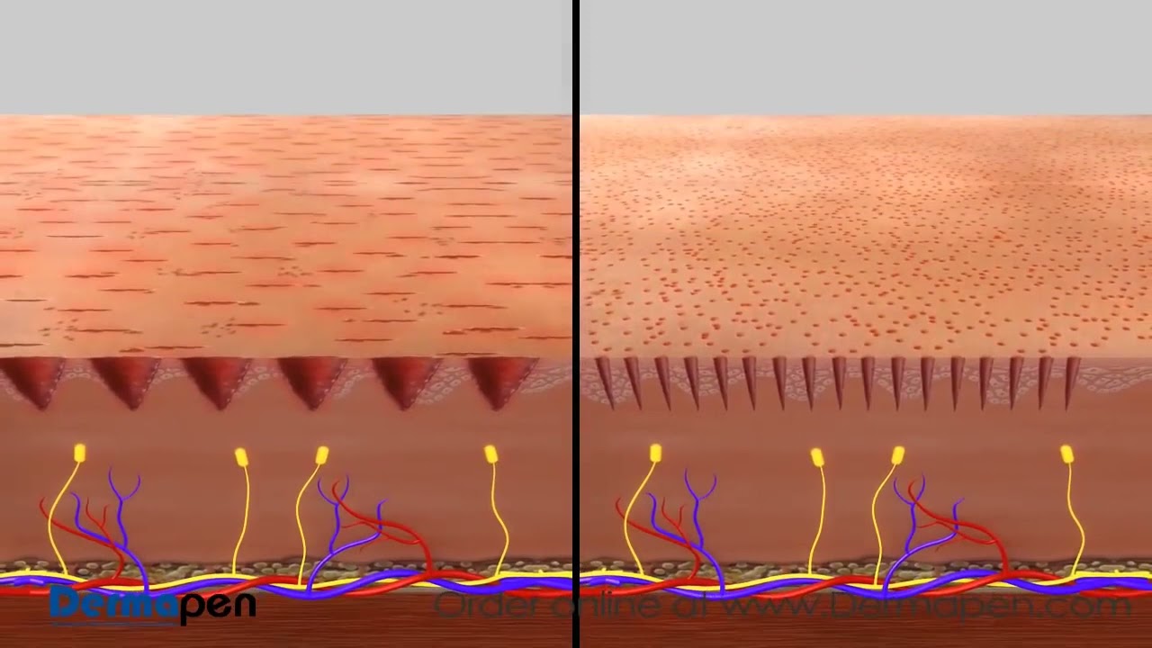 Derma Pen Vs Derma roller for Beard and Hair Growth