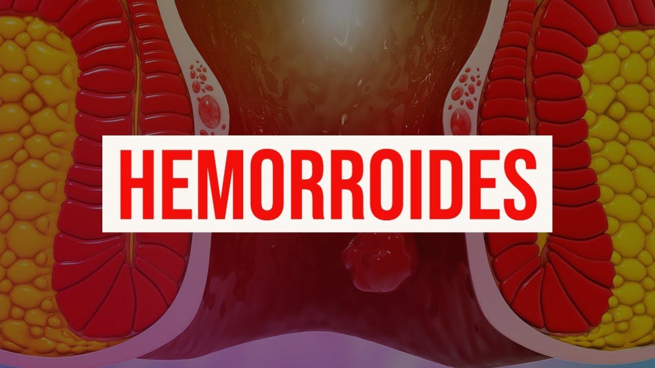Hemorroides: causas, diagnóstico, síntomas, tratamiento y prevención (almorranas y sangrado rectal)