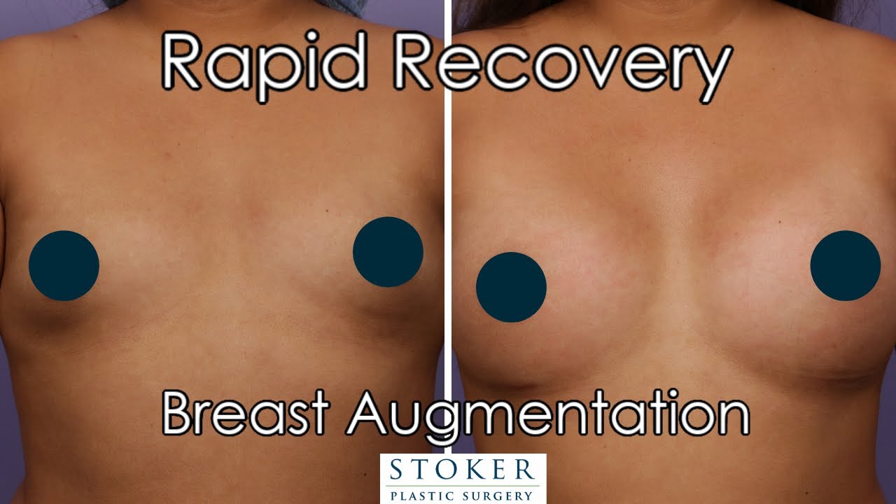 Rapid Recovery Breast Augmentation: Los Angeles Plastic Surgeon Dr. David Stoker Explains