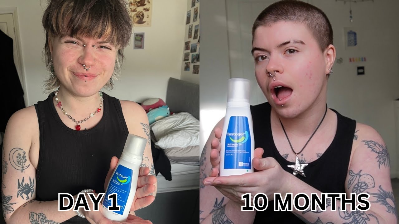 10 MONTHS ON TESTOSTERONE UPDATE!!