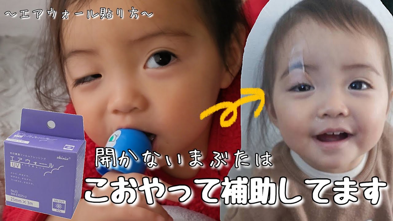 【産まれつき開かない瞼でも、視力を発達させる為に☝️】先天性眼瞼下垂はなちゃん🌼*ﾟWinkkids😉