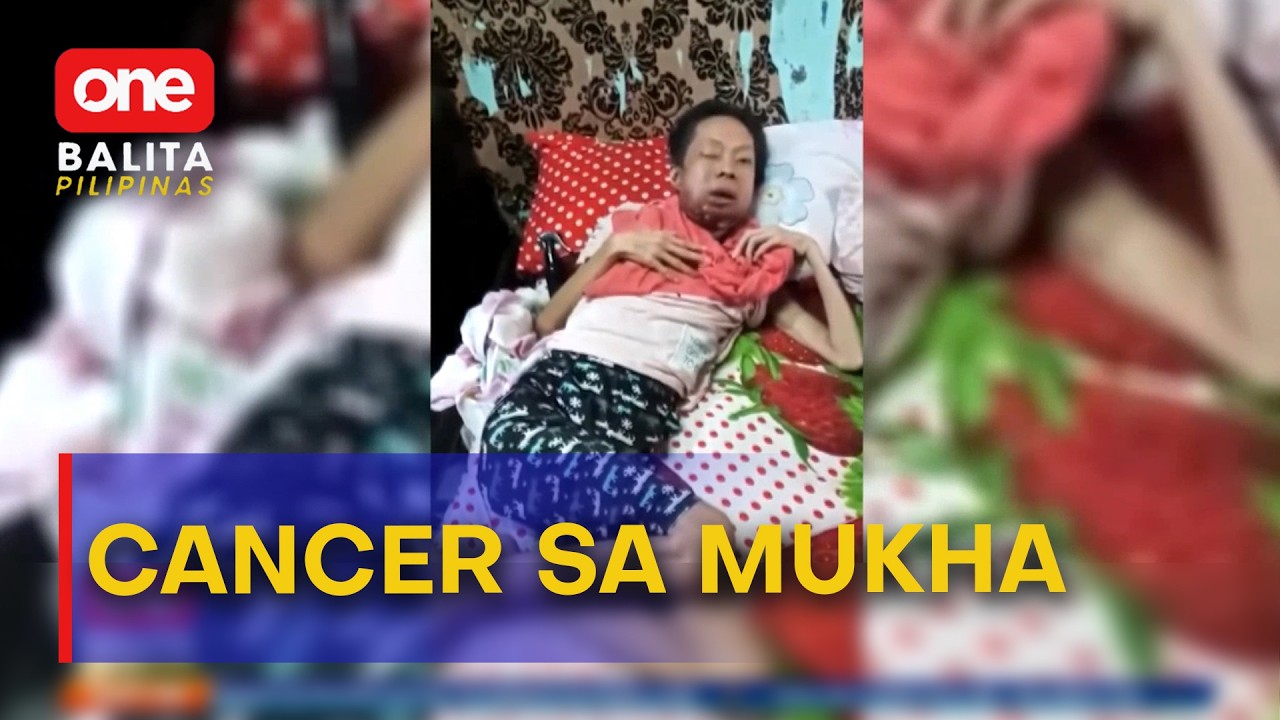 Pananakit ng bibig ng ina sa Antipolo, nauwi sa stage 3 cancer sa mukha | One Balita Pilipinas