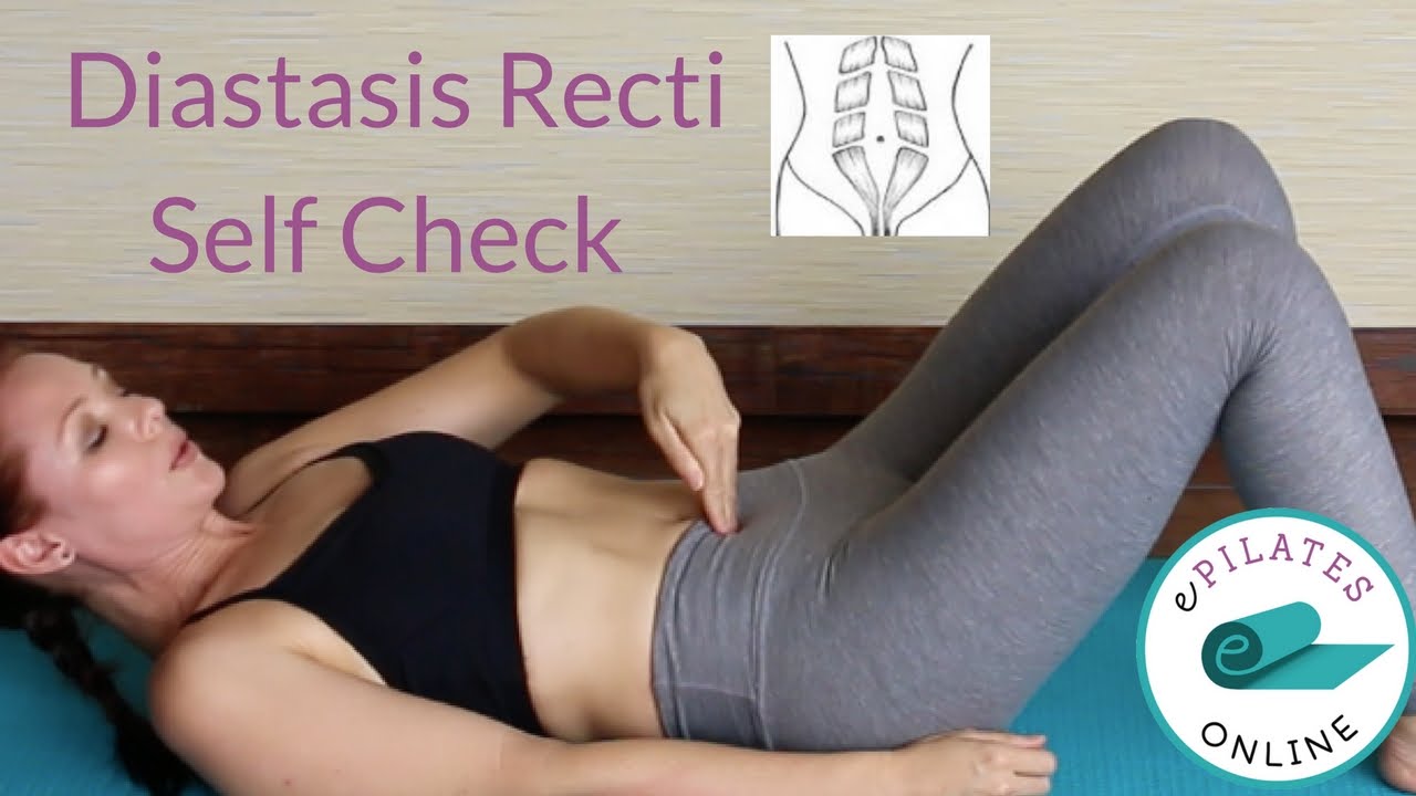 How to check for Diastasis Rectis or separation of the abdominals  - self check test