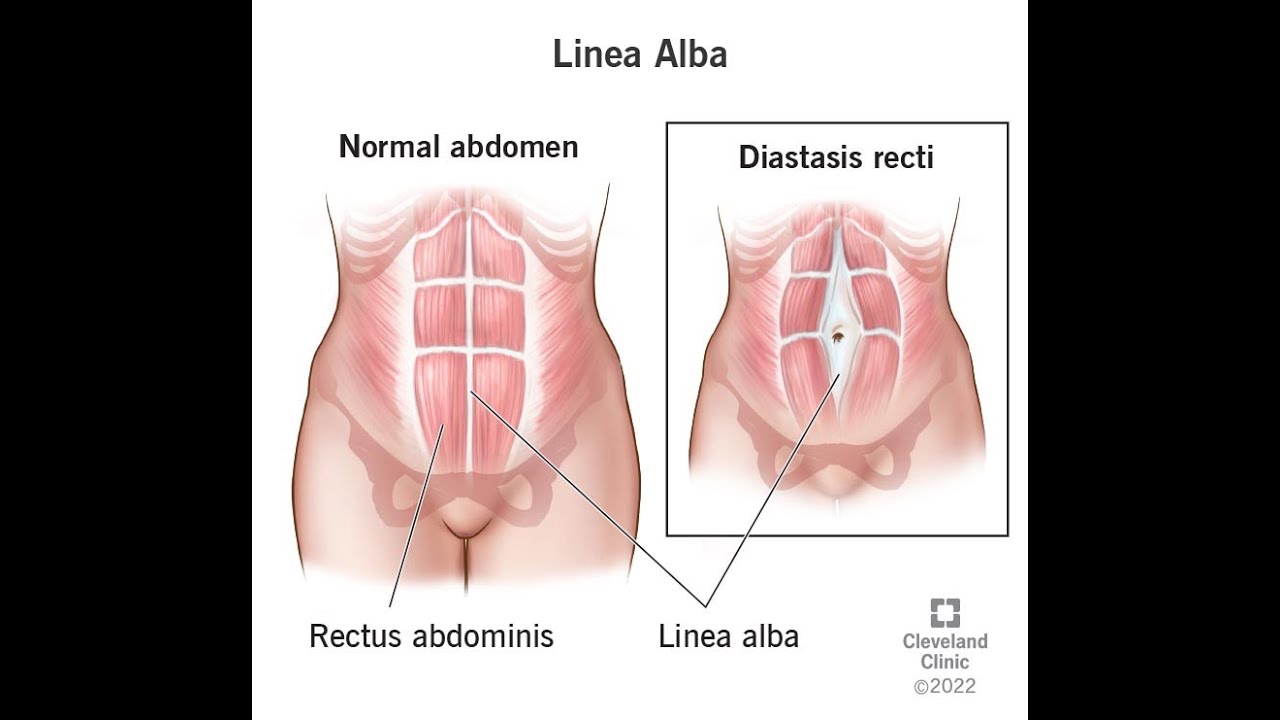 Understanding the Significance of the Linea Alba in Anatomy