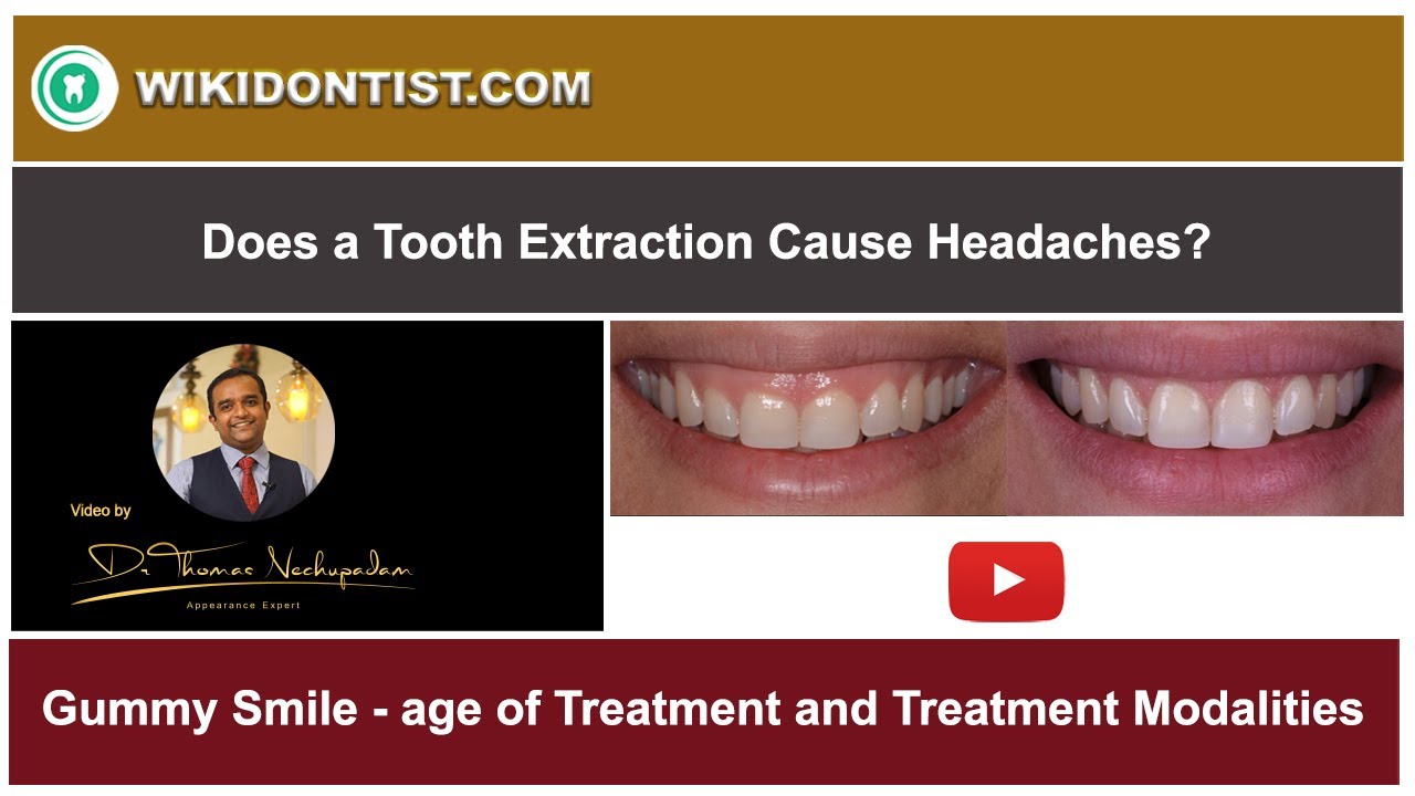 Gummy Smile - age of Treatment and Treatment Modalities