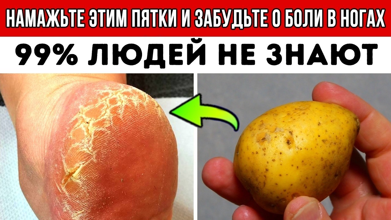 Ноги перестанут КРУТИТЬ и пятки всегда 