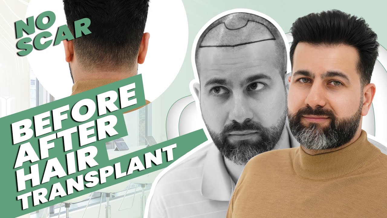 Before and  After Hair Transplant