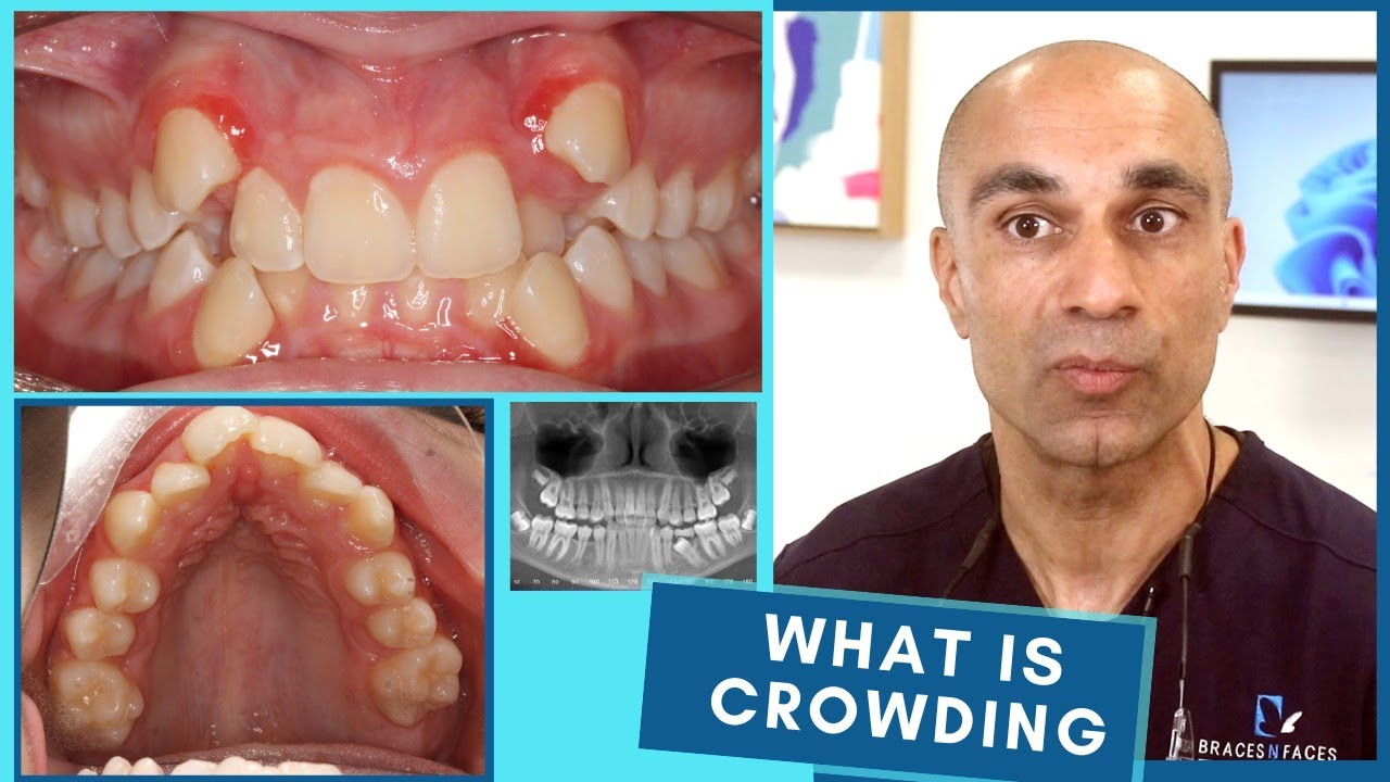 How To Fix Dental Crowding with Braces?