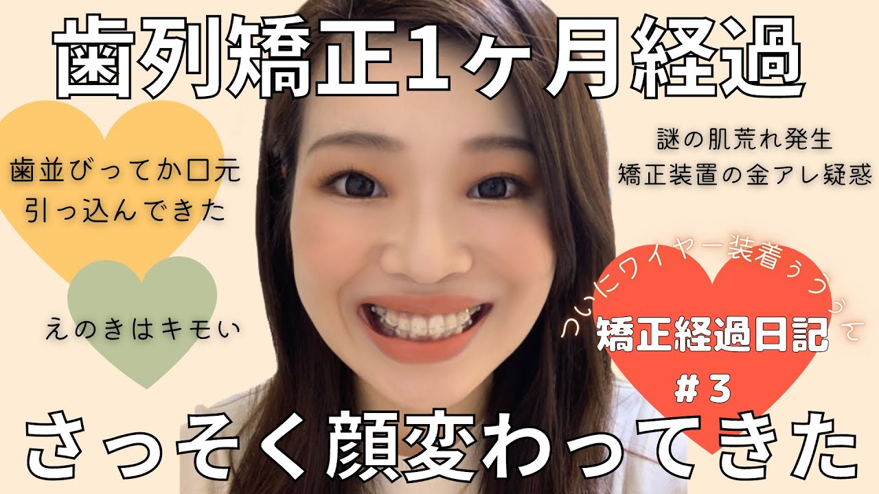 【歯列矯正日記#3】1ヶ月経過で口ゴボ改善してきた。横顔や口元の変化や痛みやニキビ多発で金アレ疑惑