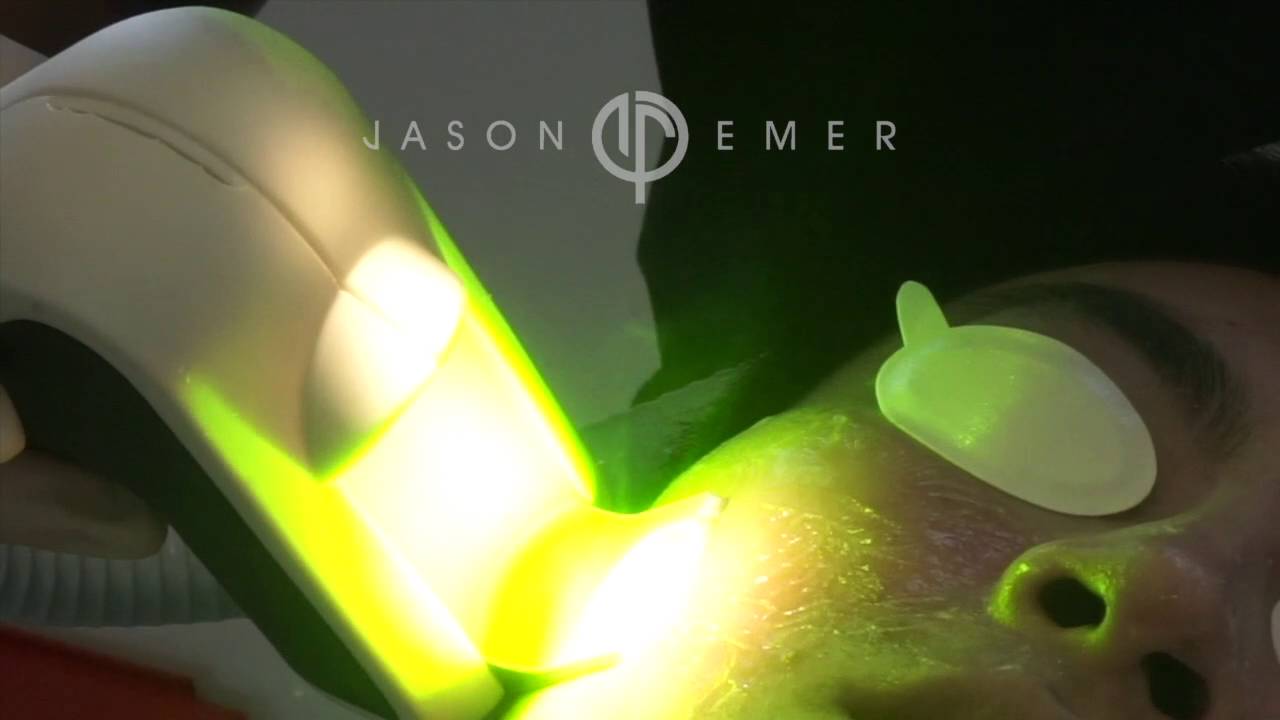 QuadroStar Pro Yellow Laser / Rosacea Skin Redness Treatment / Beverly Hills, California