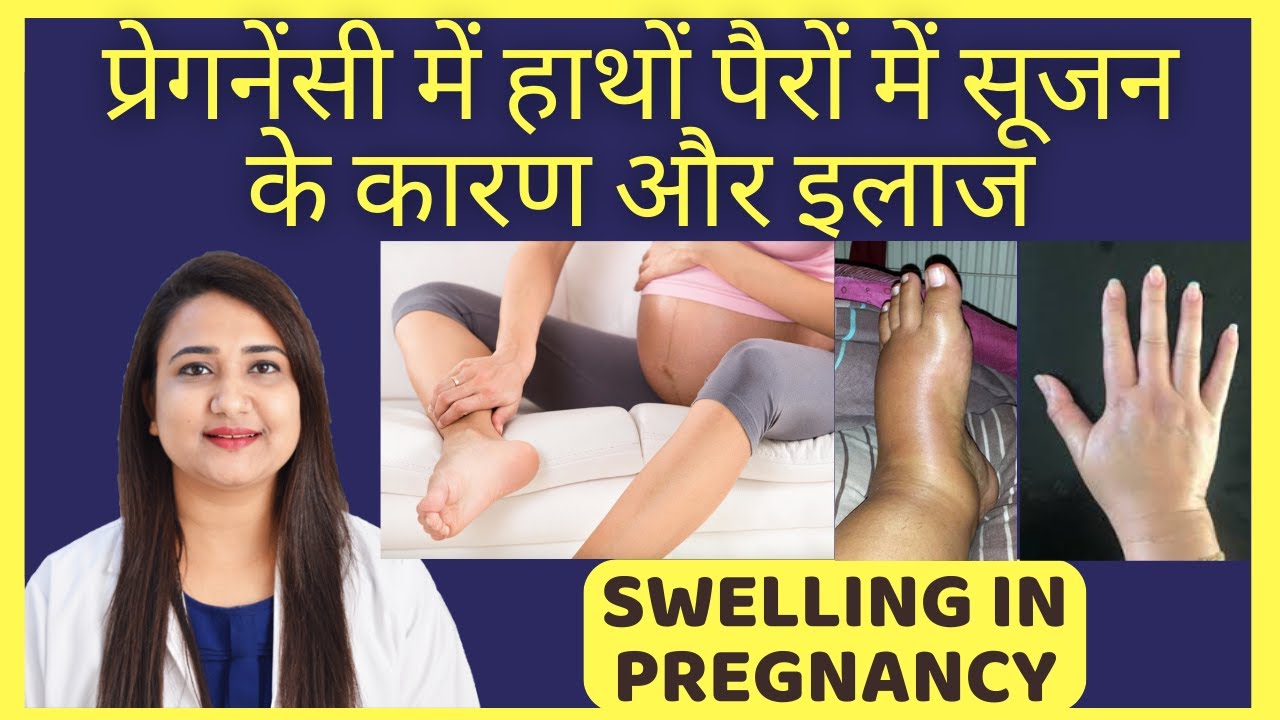 प्रेगनेंसी में हाथ पैर में सूजन कैसे ठीक करे ? SWELLING IN PREGNANCY