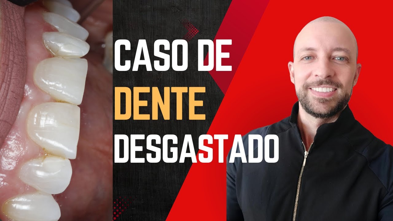 Dentes desgastados? Veja como resolvi este caso!