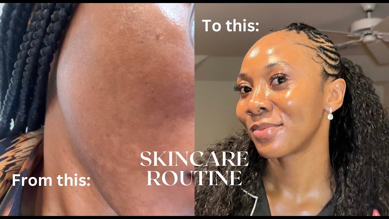 How to get rid of dark spot/hyperpigmentation | Need clear skin? DO THIS!!