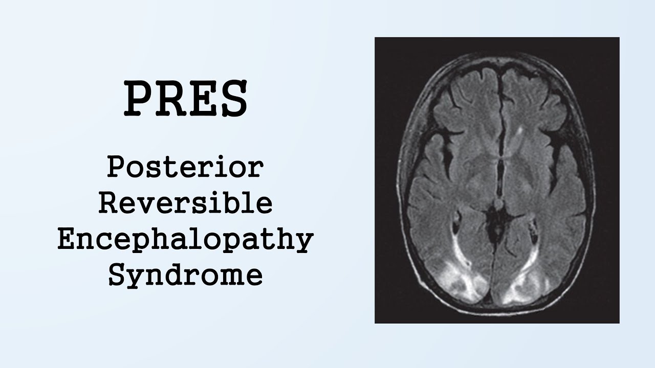 PRES (Posterior Reversible Encephalopathy Syndrome)