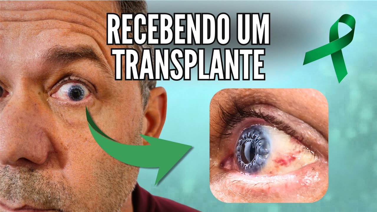 Passei por um Transplante de Córnea: cirurgia e recuperação + entrevista com Dra. Luciene Barbosa