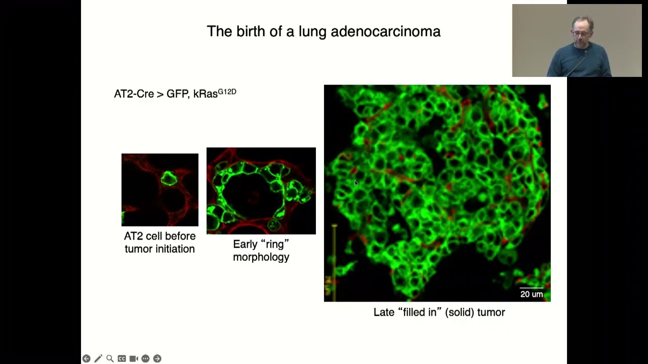 How Lung Cancer Begins: Alveolar Stem Cells and Initiation of Adenocarcinoma – Mark A. Krasnow