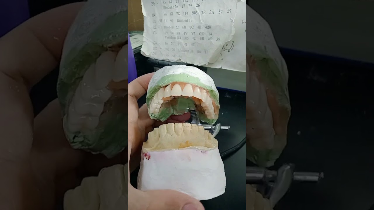 Upper full denture set up with metal mesh ❤️