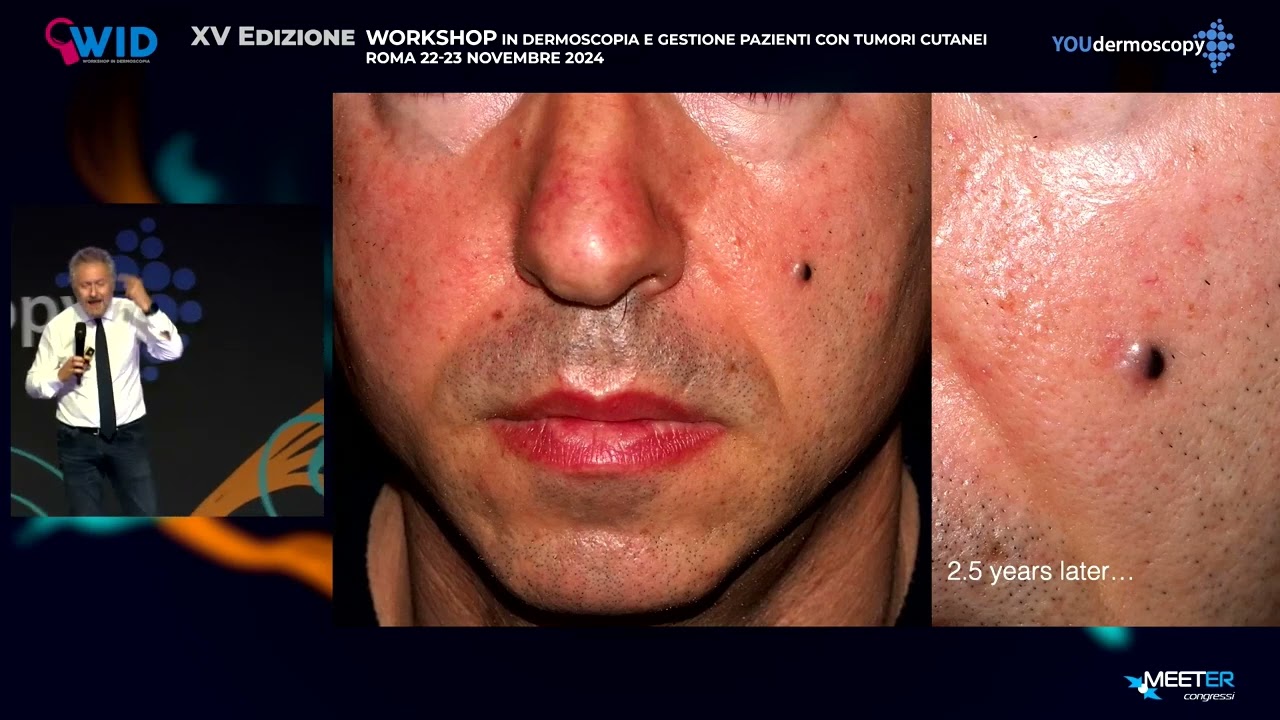XV Workshop - G. Argenziano - La classificazione WHO dei tumori melanocitari vista dal clinico